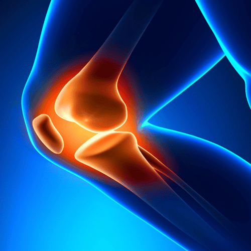 Los 3 países más baratos para la cirugía de reemplazo de rodilla